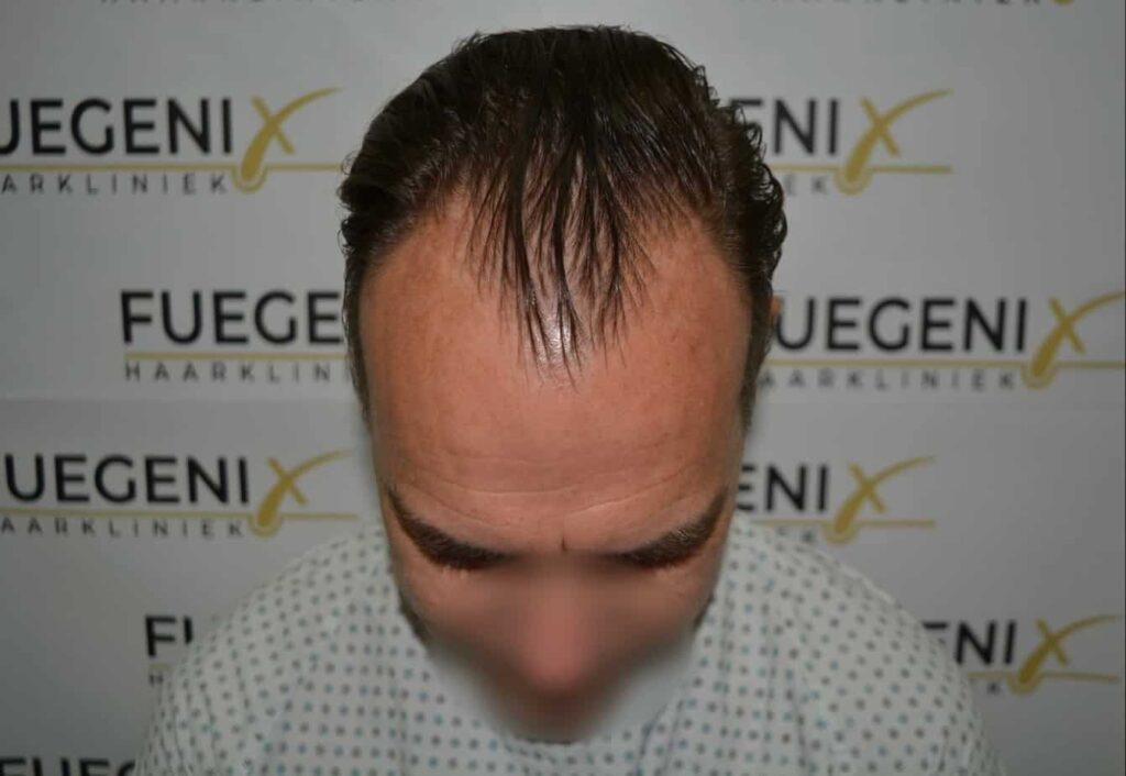Hairline Artistry At Its Best