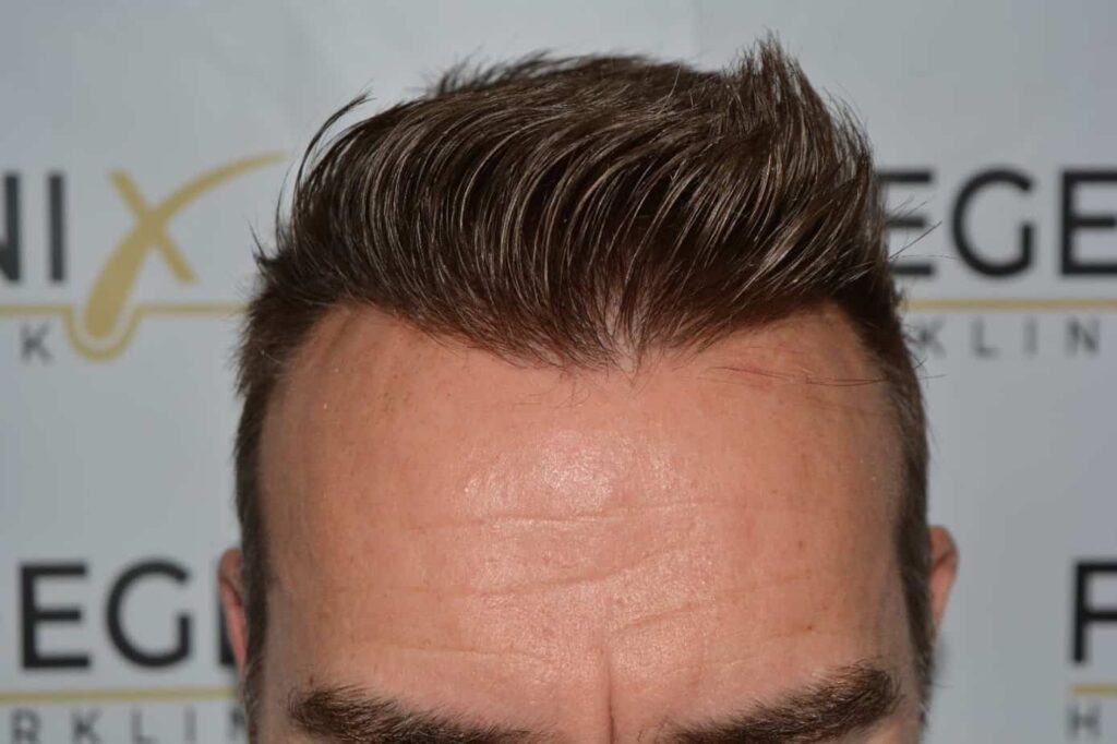 Hairline Artistry At Its Best