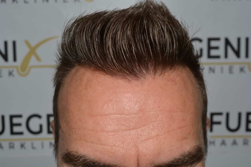 Hairline Artistry At Its Best