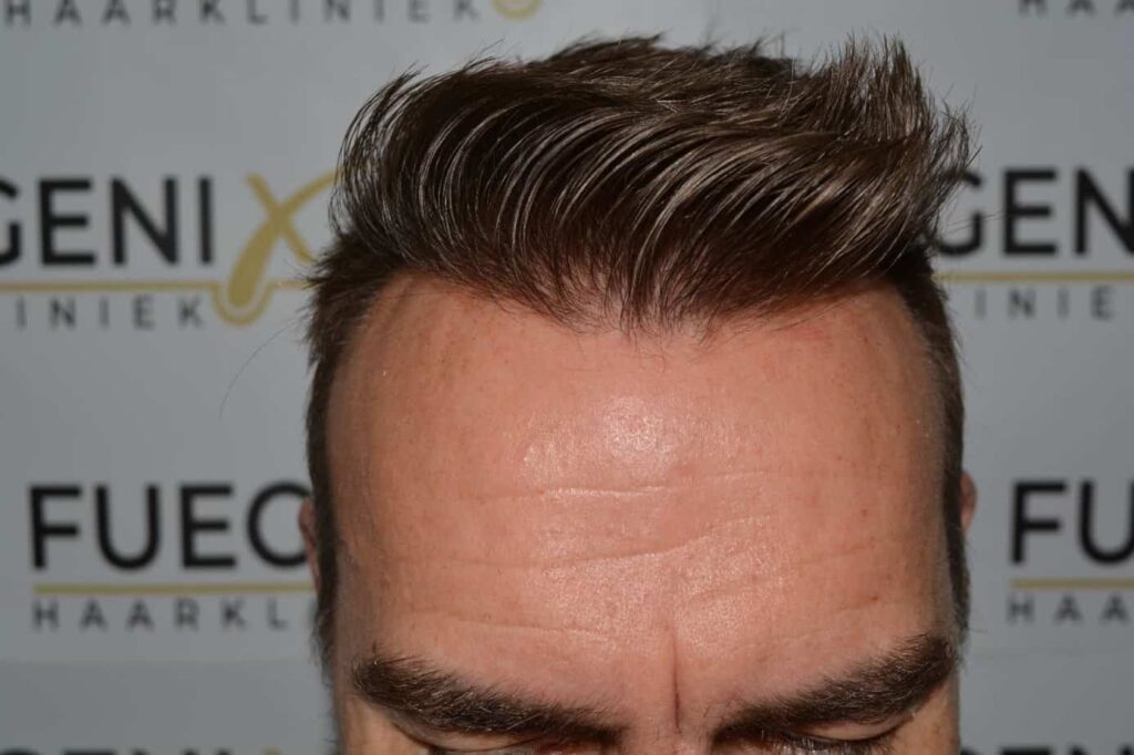 Hairline Artistry At Its Best