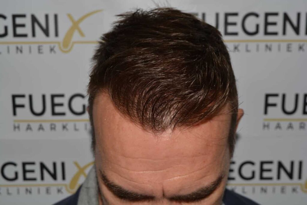 Hairline Artistry At Its Best