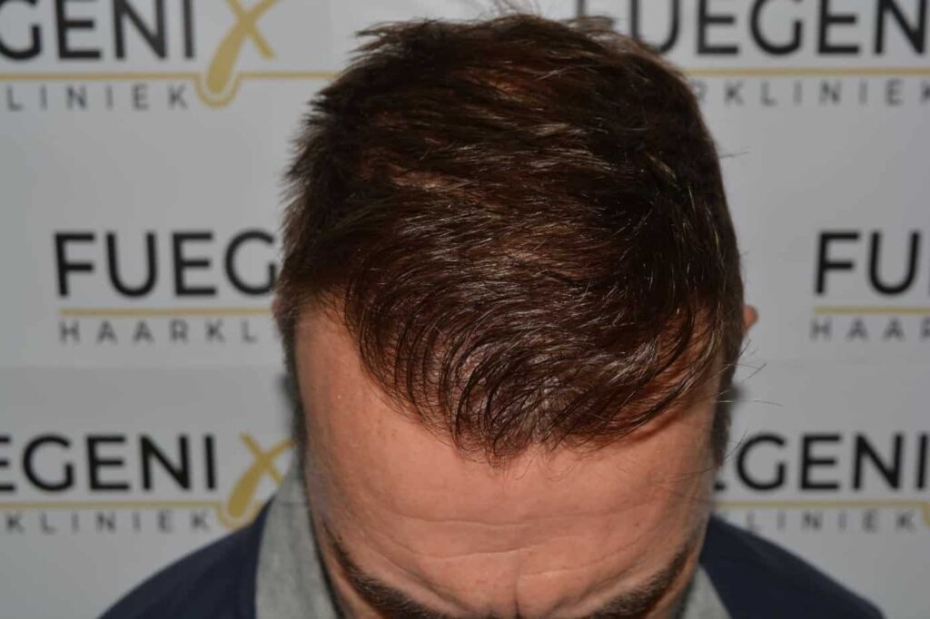 Hairline Artistry At Its Best