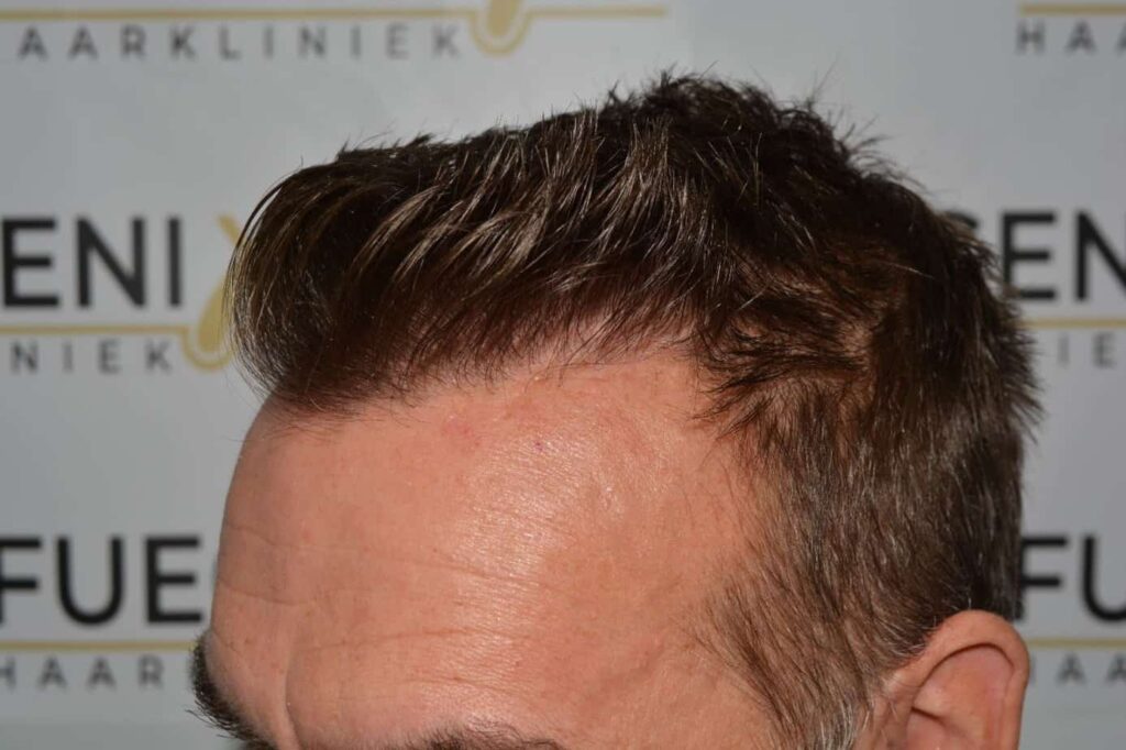 Hairline Artistry At Its Best