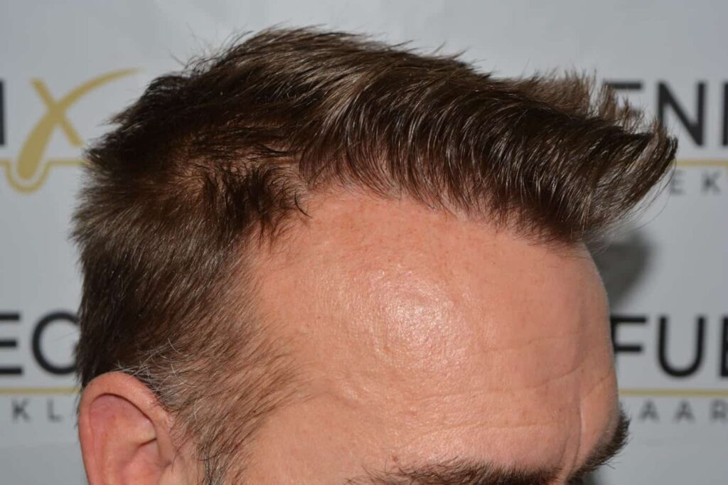 Hairline Artistry At Its Best