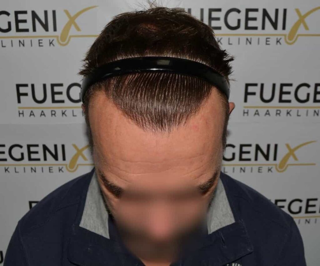 Hairline Artistry At Its Best