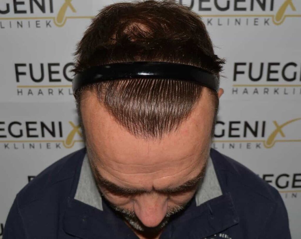 Hairline Artistry At Its Best