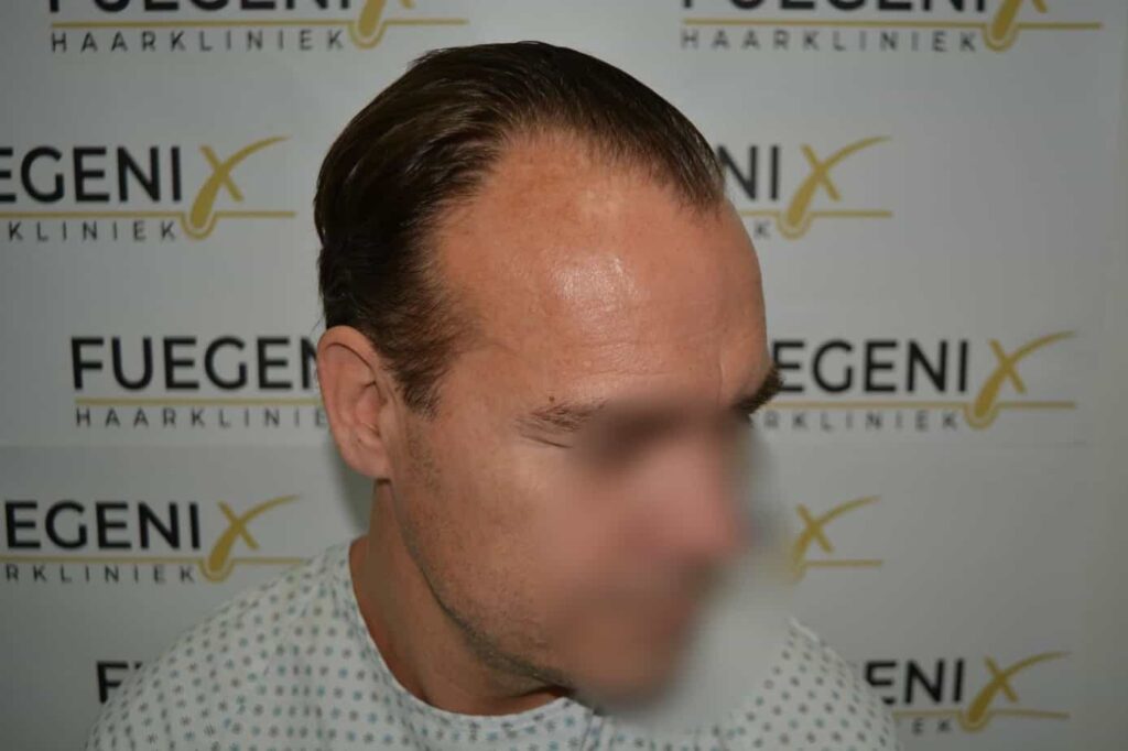 Hairline Artistry At Its Best