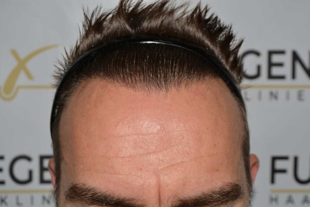 Hairline Artistry At Its Best