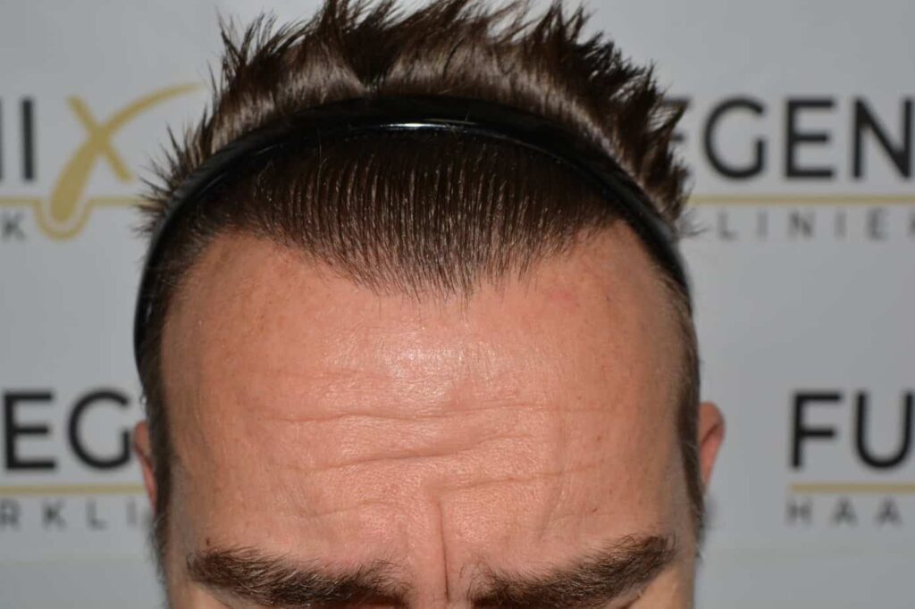 Hairline Artistry At Its Best
