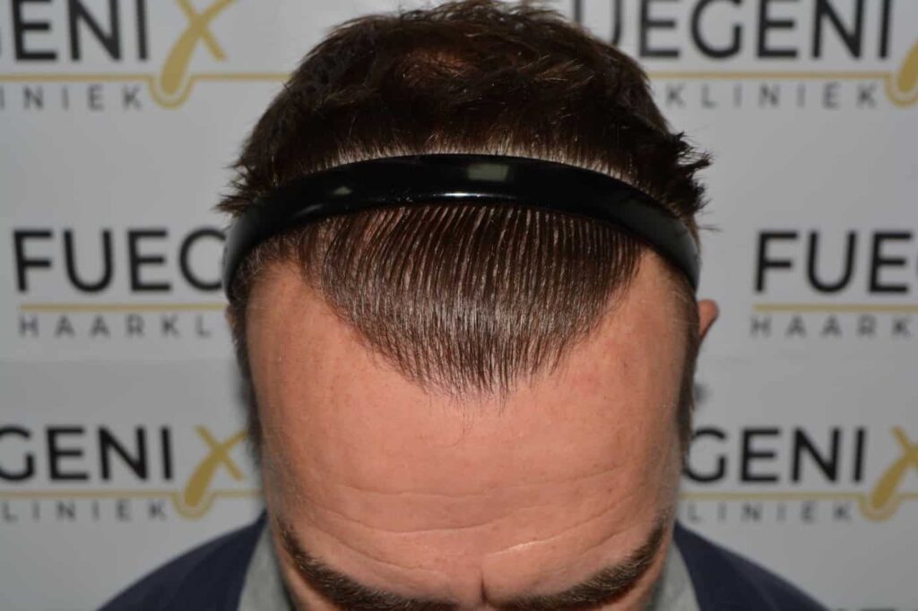 Hairline Artistry At Its Best