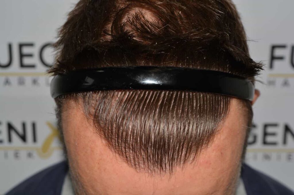 Hairline Artistry At Its Best