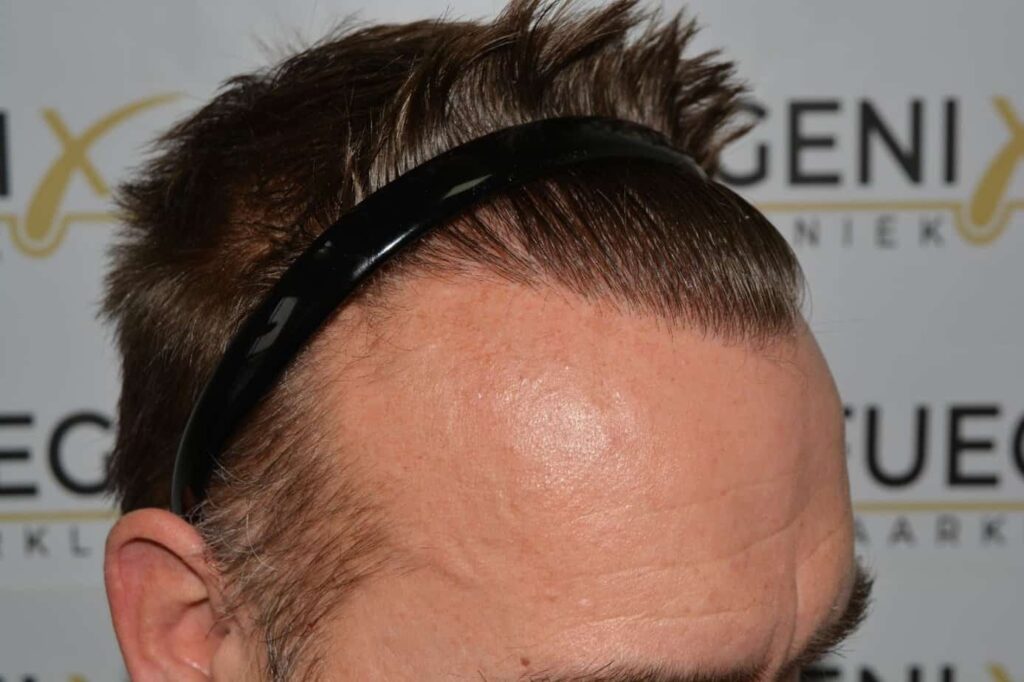 Hairline Artistry At Its Best