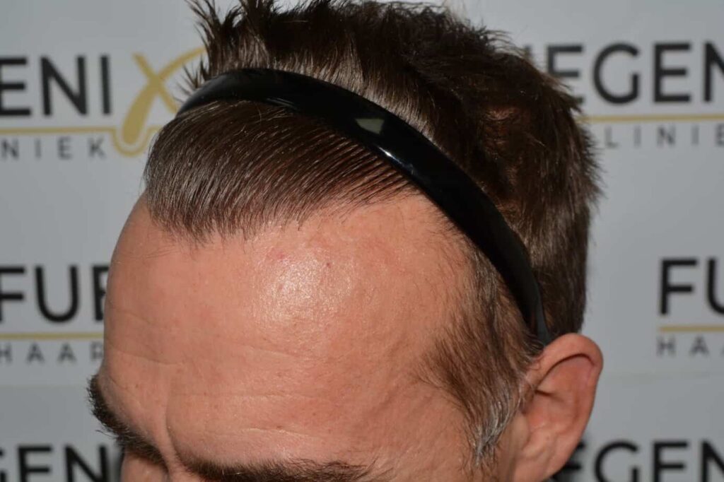 Hairline Artistry At Its Best