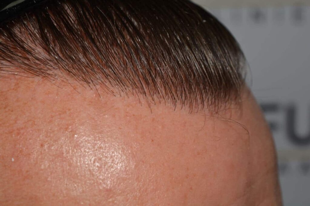 Hairline Artistry At Its Best