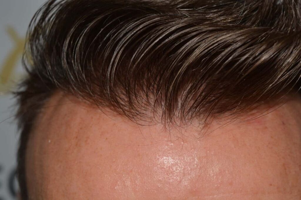 Hairline Artistry At Its Best