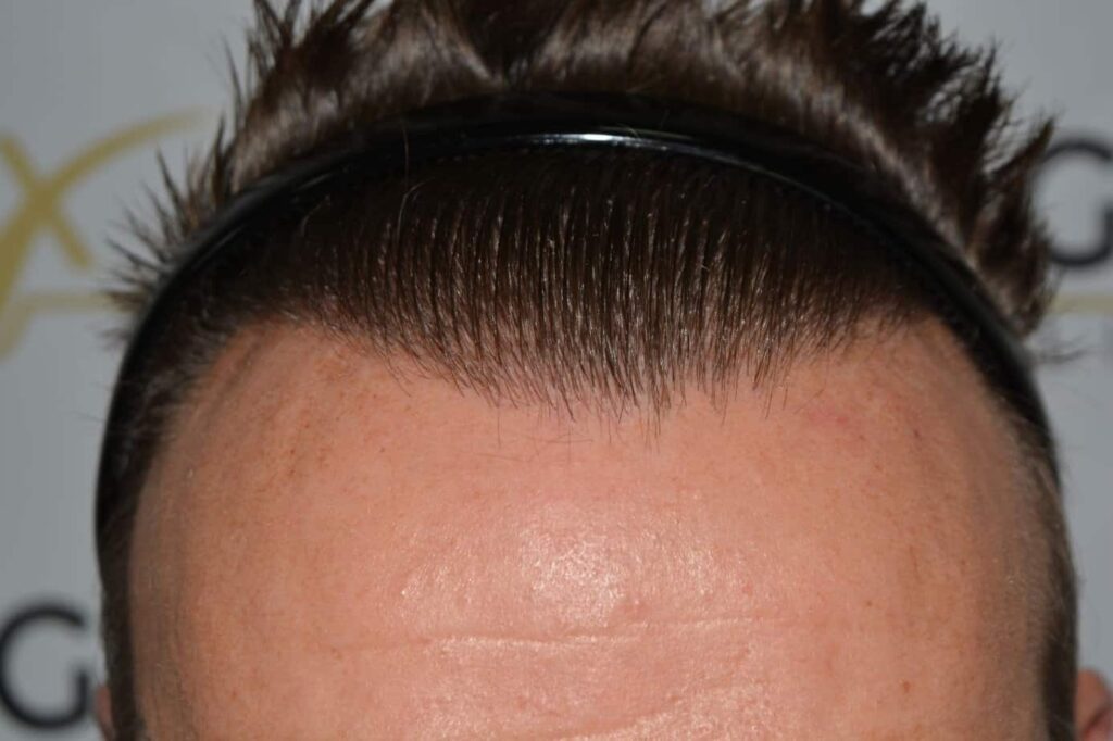Hairline Artistry At Its Best