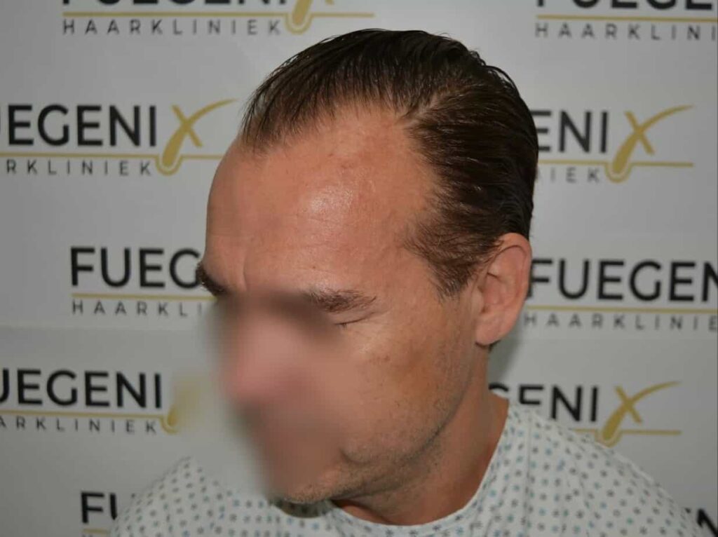 Hairline Artistry At Its Best