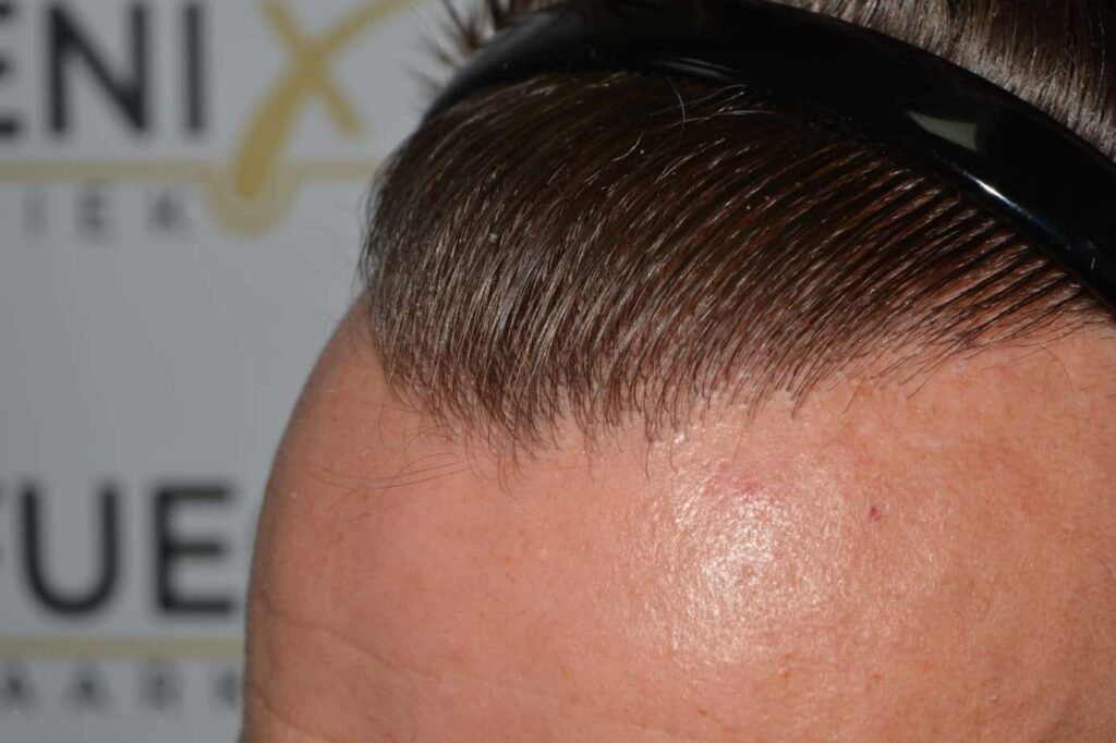 Hairline Artistry At Its Best