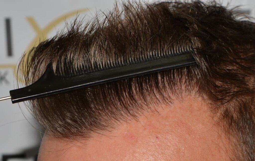 Hairline Artistry At Its Best