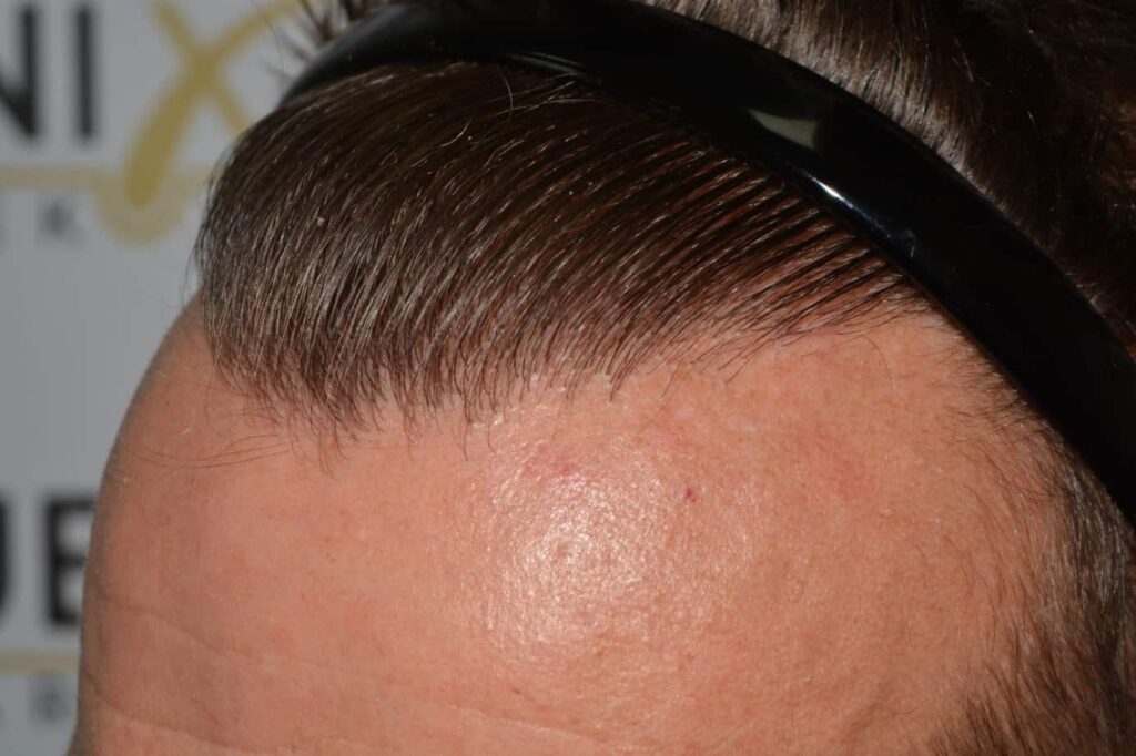 Hairline Artistry At Its Best