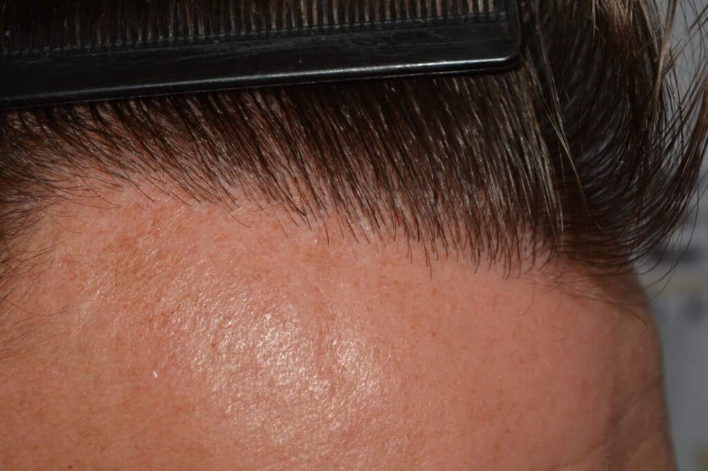 Hairline Artistry At Its Best