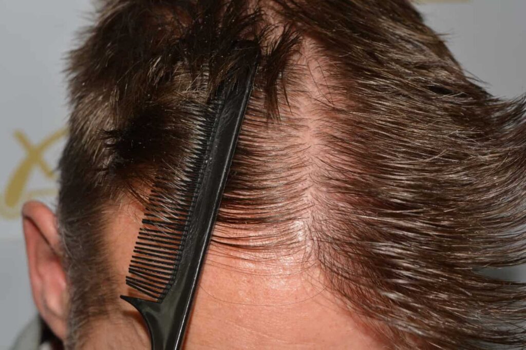 Hairline Artistry At Its Best