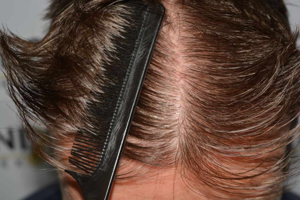 Hairline Artistry At Its Best