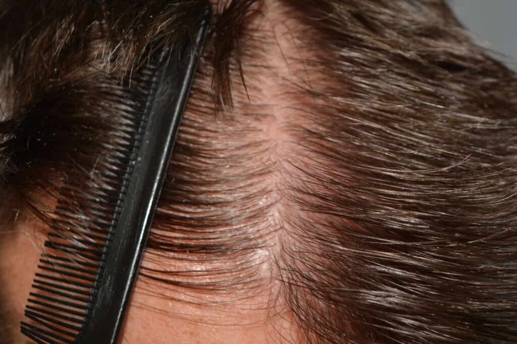 Hairline Artistry At Its Best