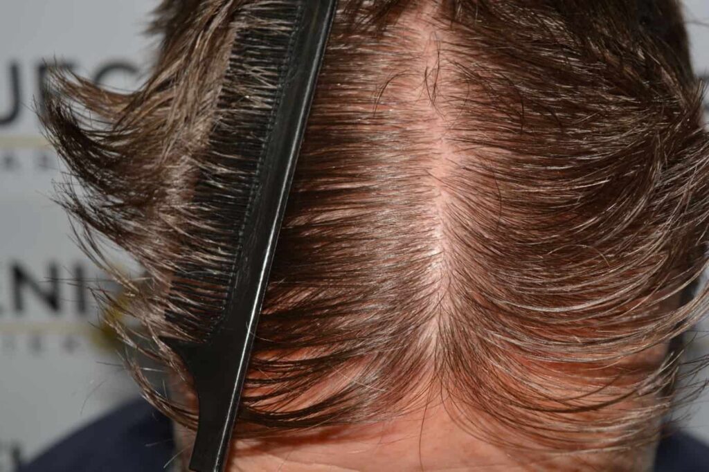 Hairline Artistry At Its Best