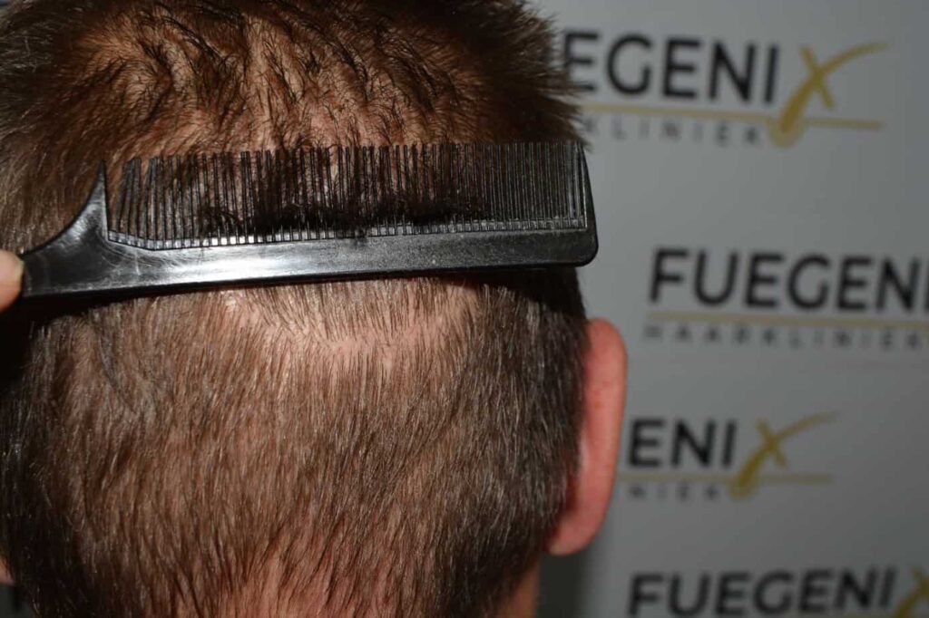 Hairline Artistry At Its Best
