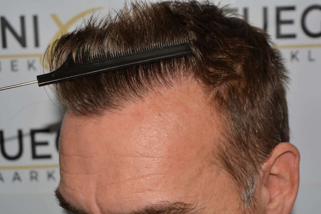 Hairline Artistry At Its Best