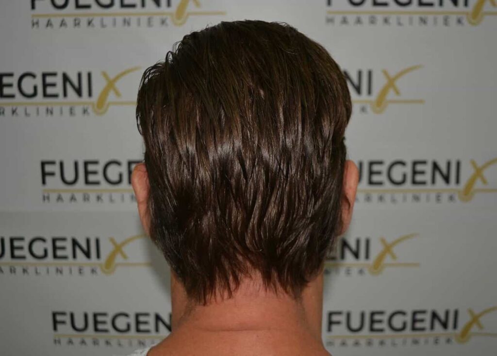Hairline Artistry At Its Best