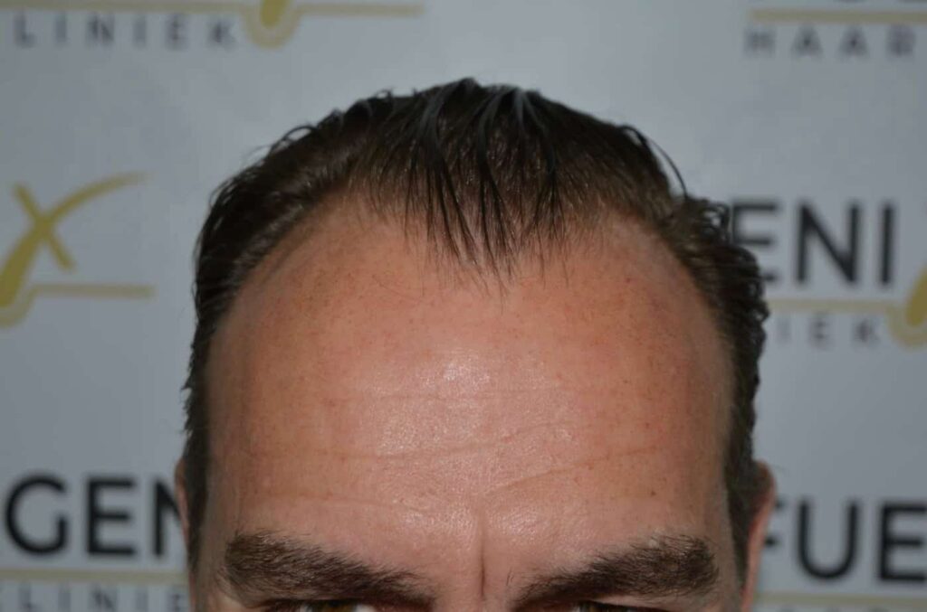 Hairline Artistry At Its Best
