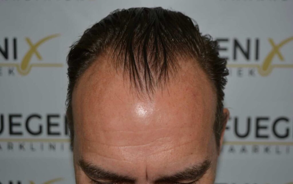 Hairline Artistry At Its Best