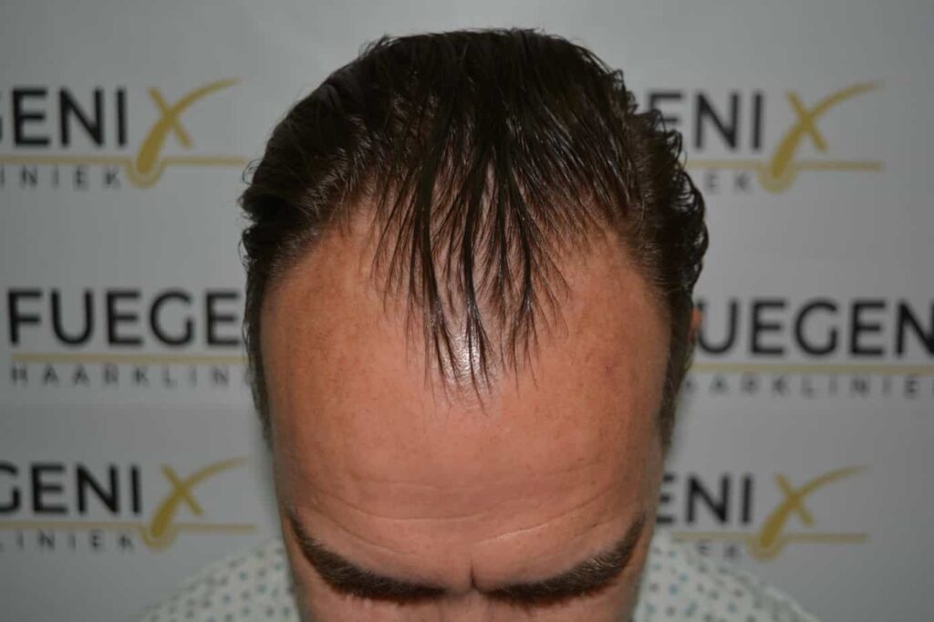 Hairline Artistry At Its Best