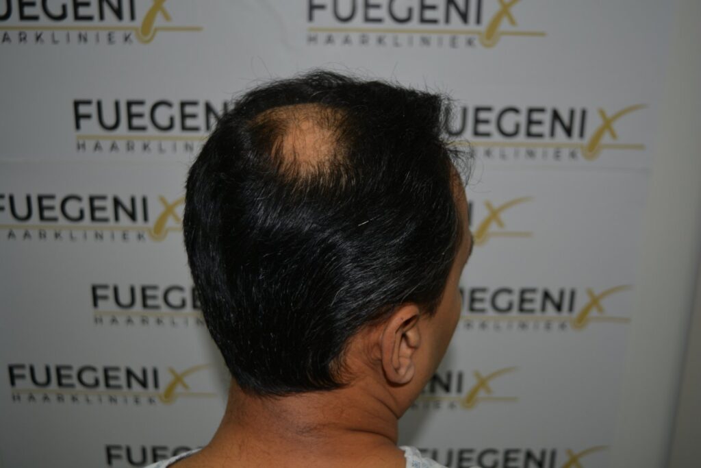 Hairline Midscalp Crown