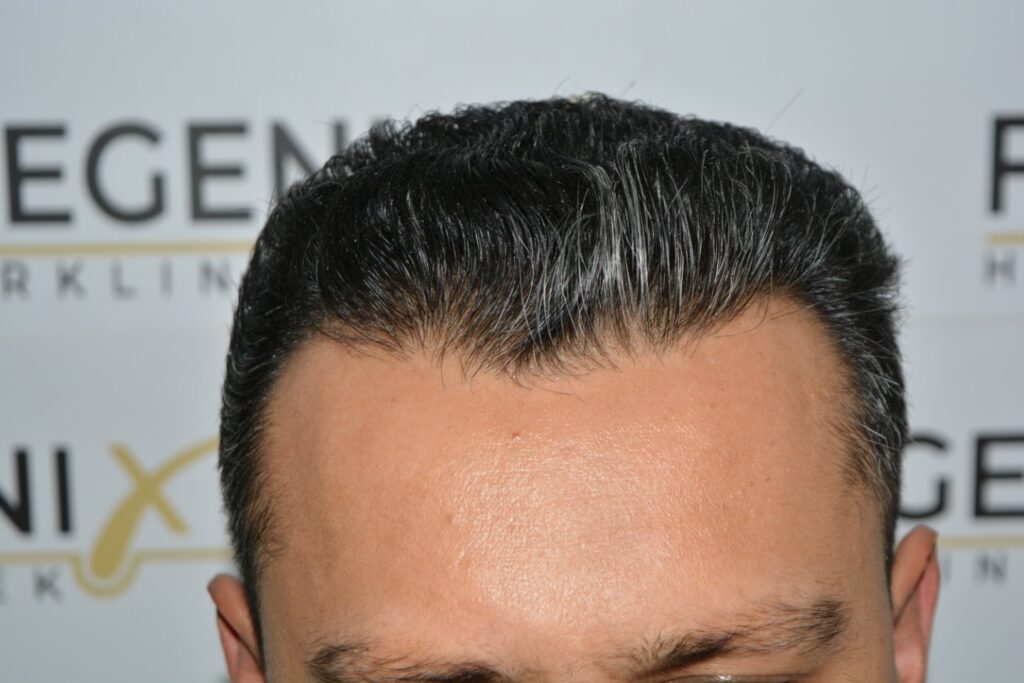 Hairline Midscalp Crown
