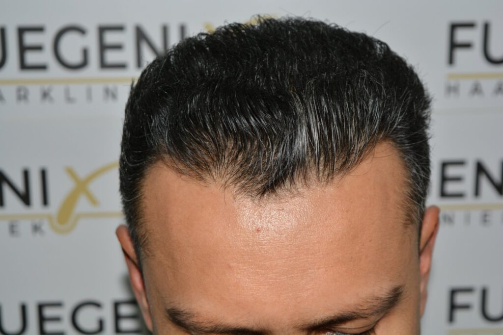 Hairline Midscalp Crown