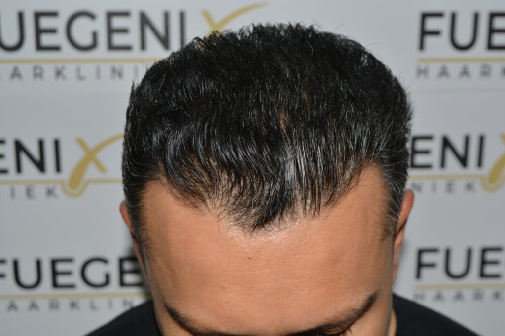 Hairline Midscalp Crown