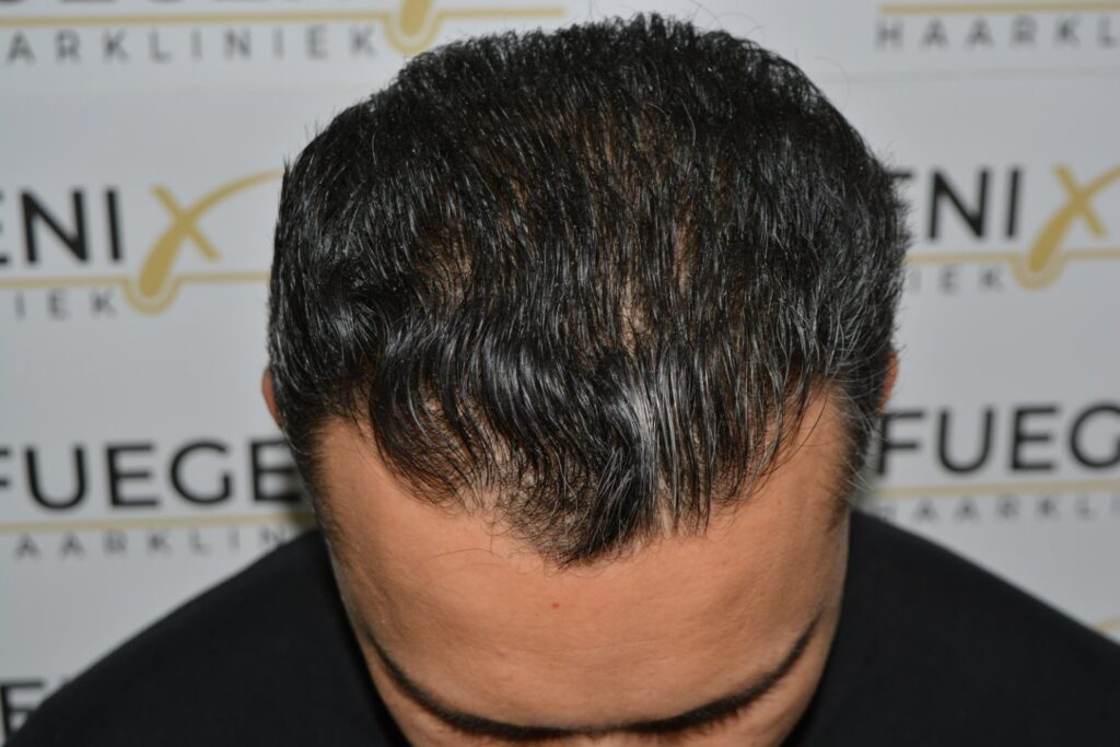 Hairline Midscalp Crown