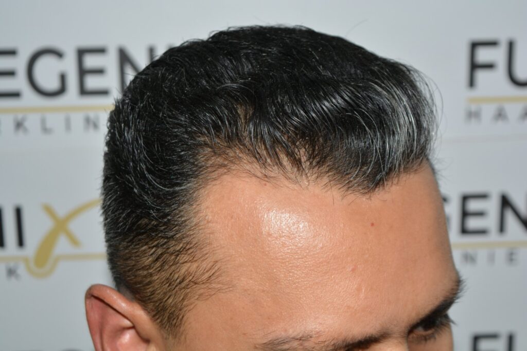 Hairline Midscalp Crown