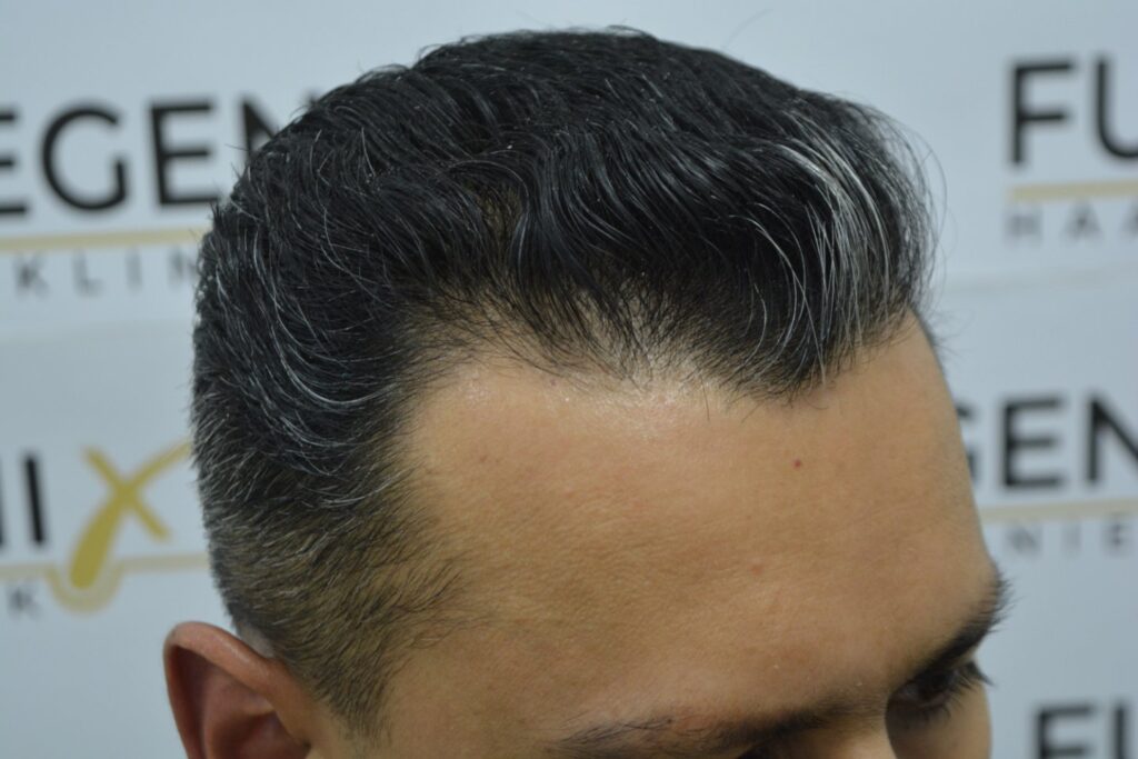 Hairline Midscalp Crown