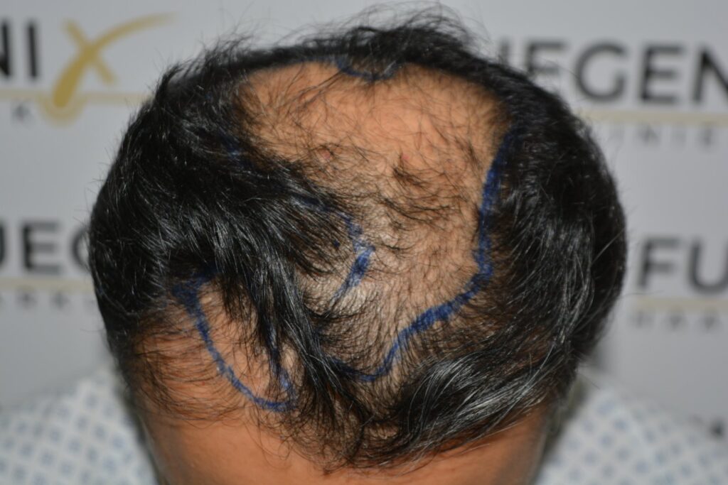 Hairline Midscalp Crown