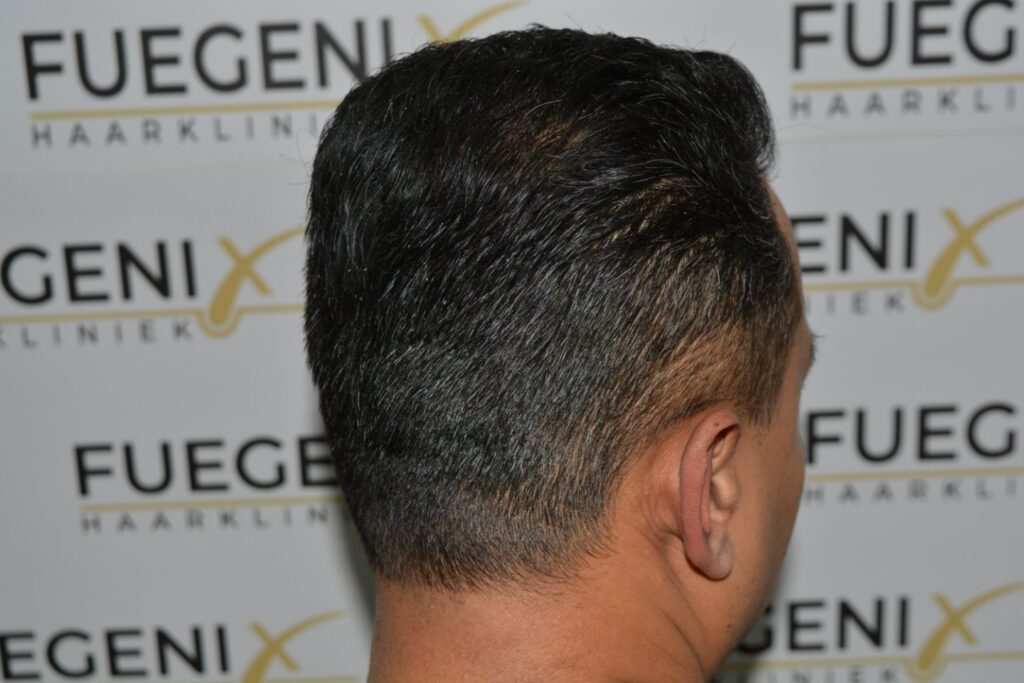 Hairline Midscalp Crown