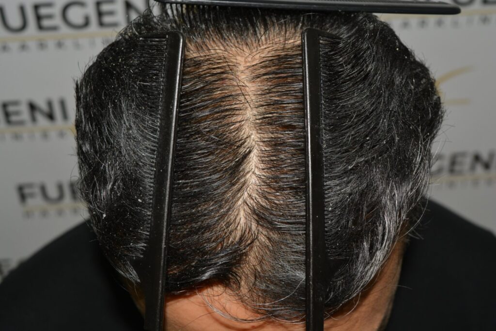 Hairline Midscalp Crown