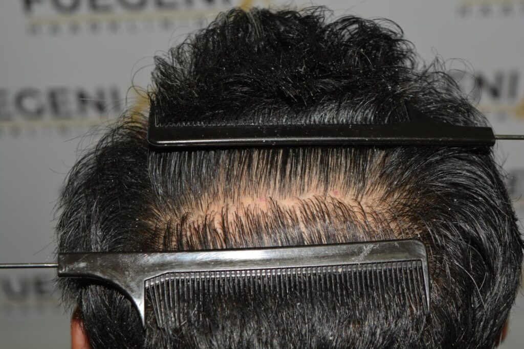 Hairline Midscalp Crown