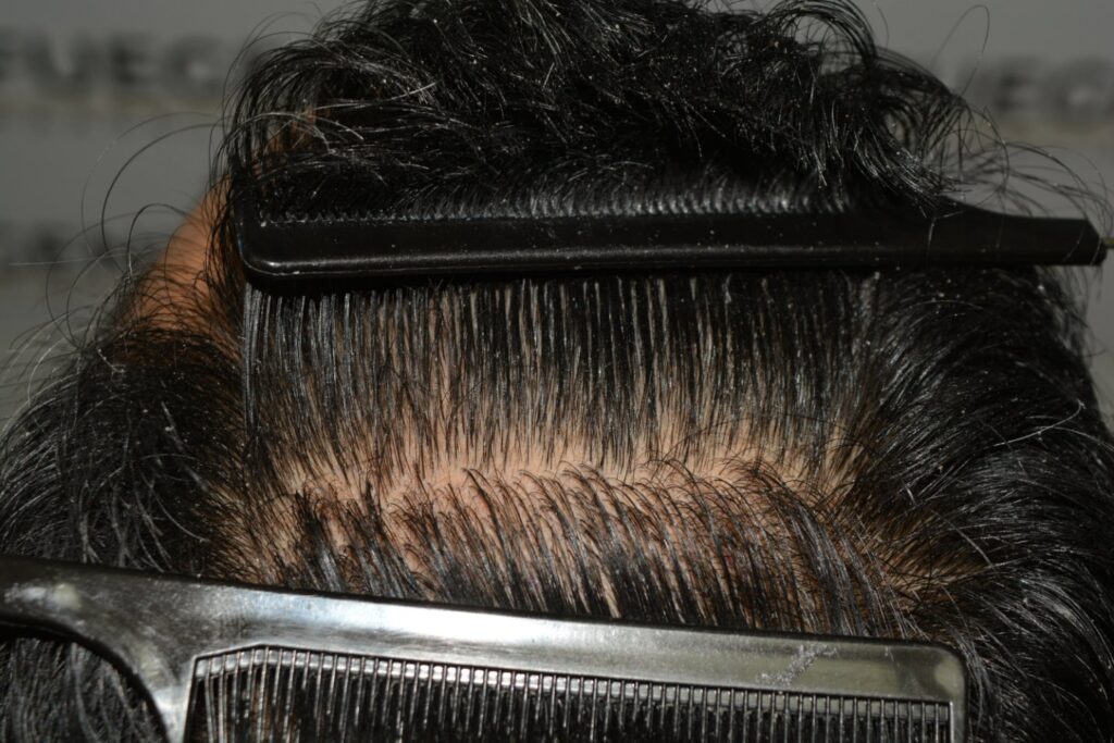 Hairline Midscalp Crown