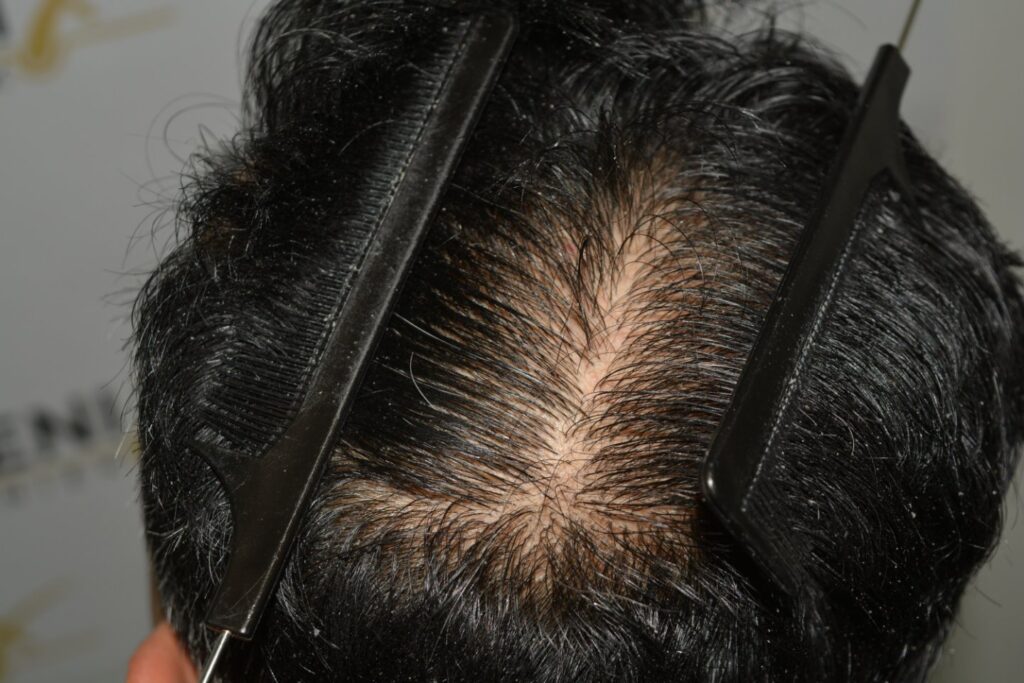 Hairline Midscalp Crown