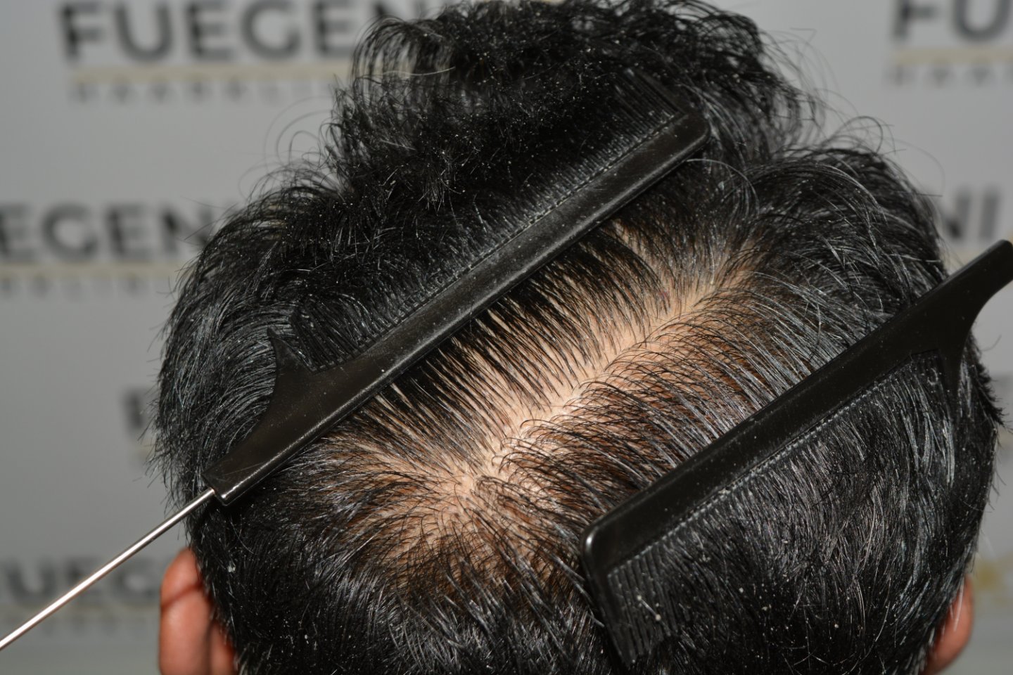 After – Hairline Midscalp Crown