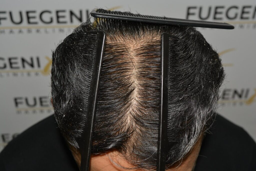 Hairline Midscalp Crown